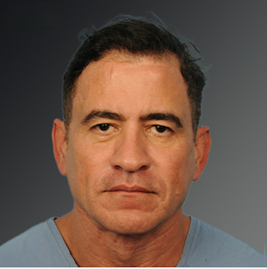 Patient 153586 | Front View | Before | Men's Face — Steven Teitelbaum MD -