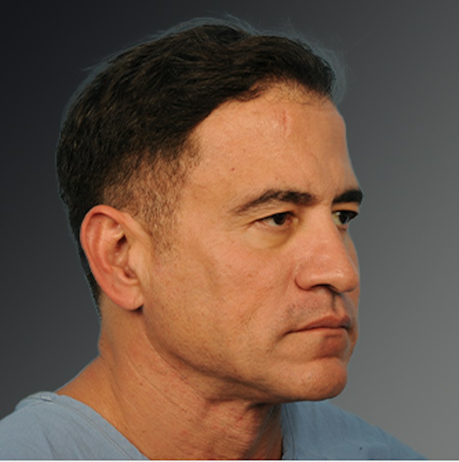 Patient 153586 | Angle View | Before | Men's Face — Steven Teitelbaum MD -