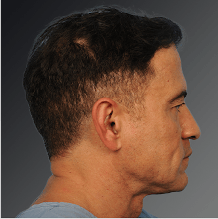 Patient 153586 | Profile View | Before | Men's Face — Steven Teitelbaum MD -