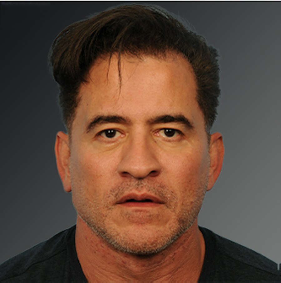 Patient 153586 | Front View | After | Men's Face — Steven Teitelbaum MD -
