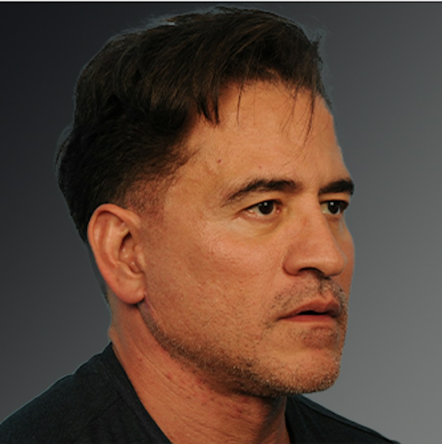 Patient 153586 | Angle View | After | Men's Face — Steven Teitelbaum MD -