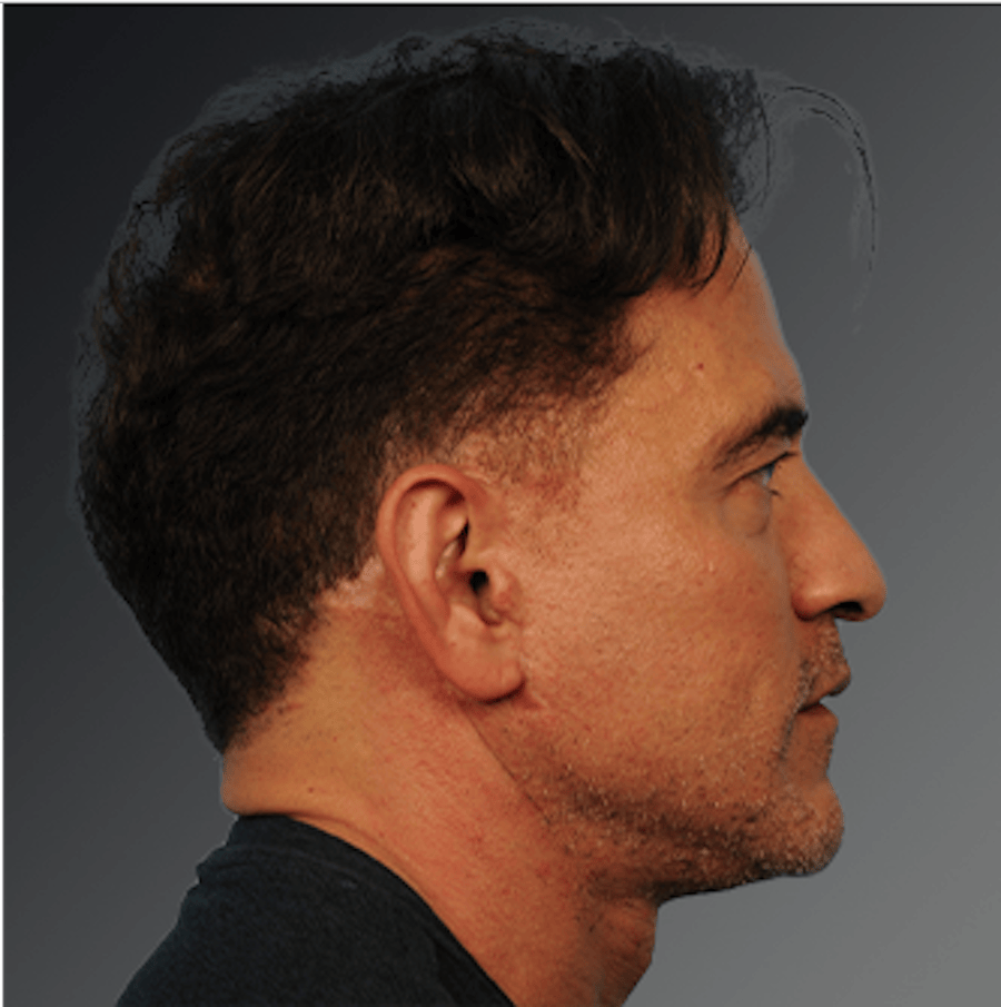 Patient 153586 | Profile View | After | Men's Face — Steven Teitelbaum MD -