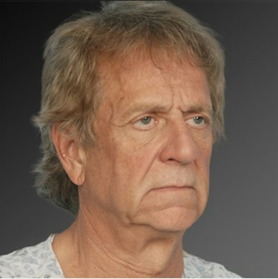 Patient 106041595 | Angle View | Before | Men's Face — Steven Teitelbaum MD -