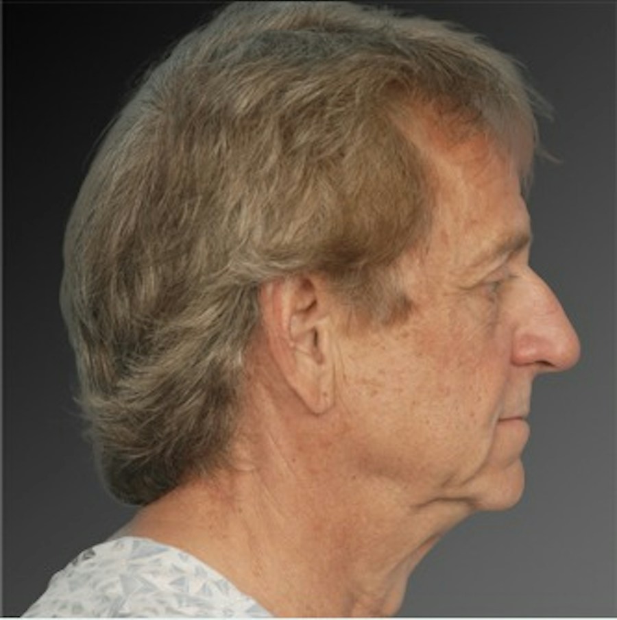 Patient 106041595 | Profile View | Before | Men's Face — Steven Teitelbaum MD -