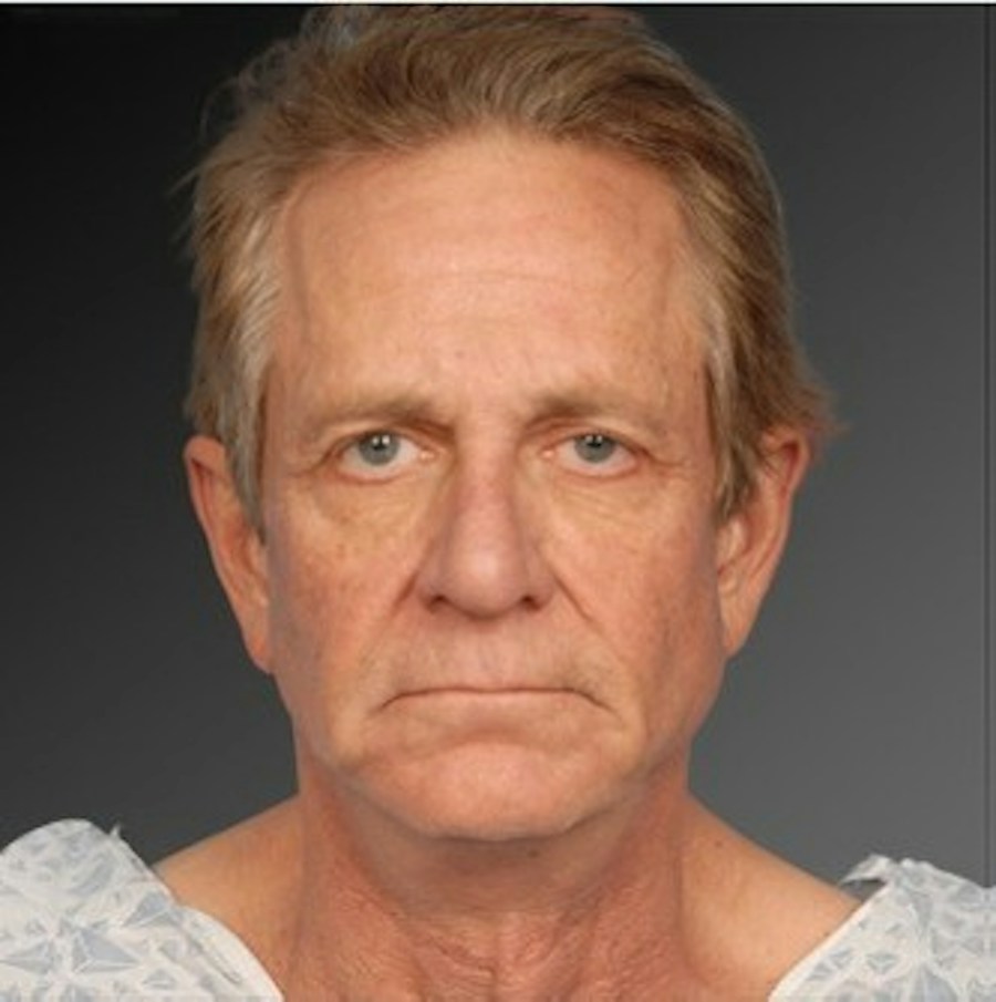 Patient 106041595 | Front View | After | Men's Face — Steven Teitelbaum MD - Santa Monica