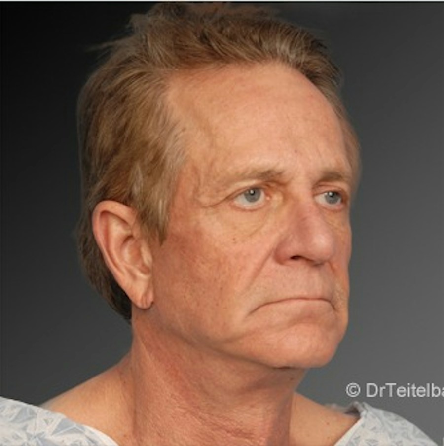 Patient 106041595 | Angle View | After | Men's Face — Steven Teitelbaum MD -