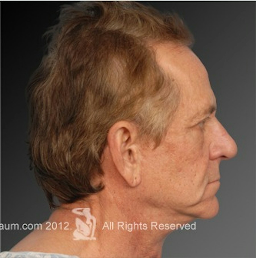 Patient 106041595 | Profile View | After | Men's Face — Steven Teitelbaum MD -