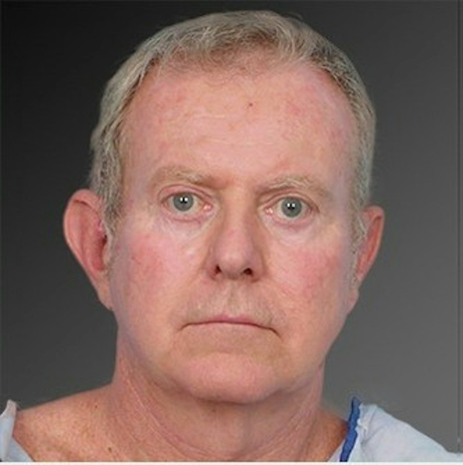 Patient 106041596 | Front View | Before | Men's Face — Steven Teitelbaum MD -