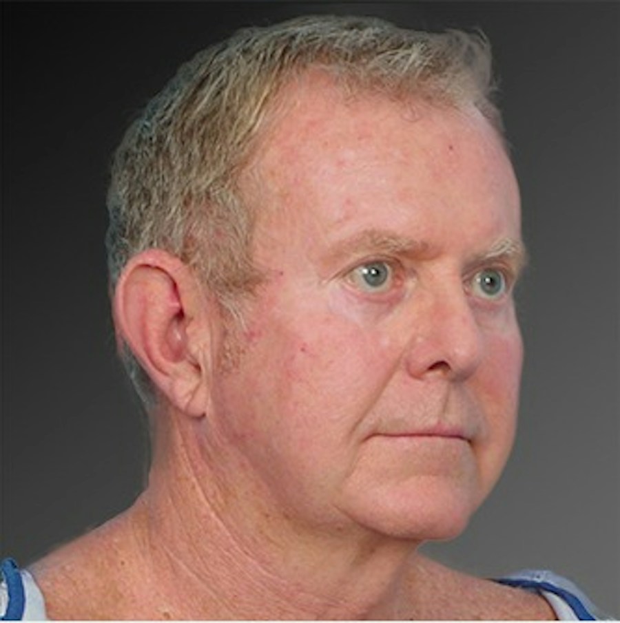Patient 106041596 | Angle View | Before | Men's Face — Steven Teitelbaum MD -