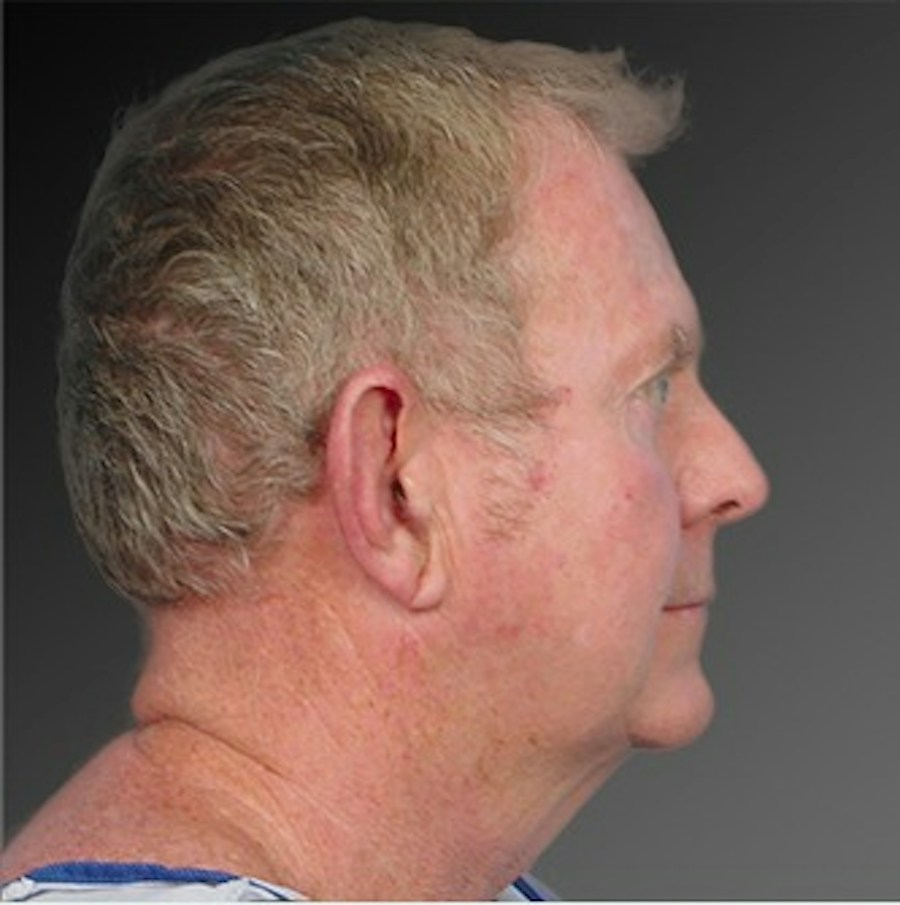 Patient 106041596 | Profile View | Before | Men's Face — Steven Teitelbaum MD -