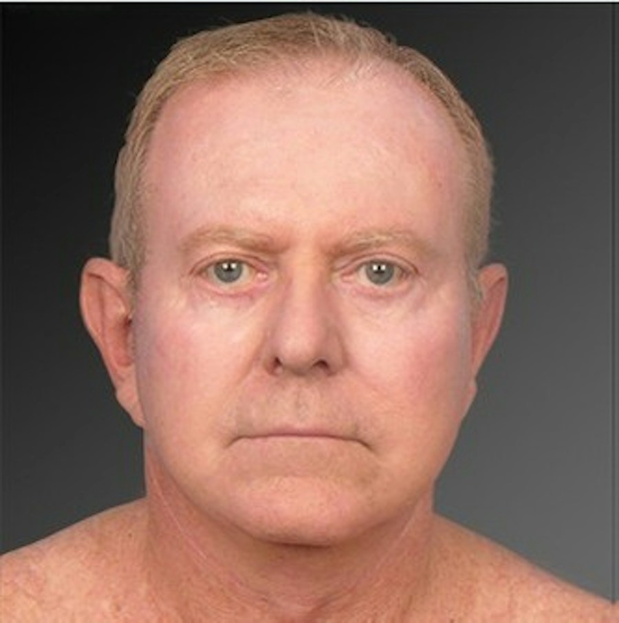 Patient 106041596 | Front View | After | Men's Face — Steven Teitelbaum MD -