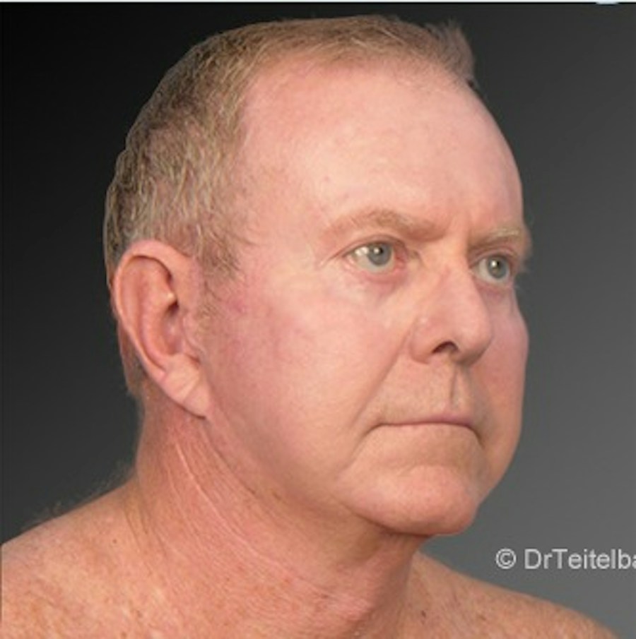 Patient 106041596 | Angle View | After | Men's Face — Steven Teitelbaum MD -