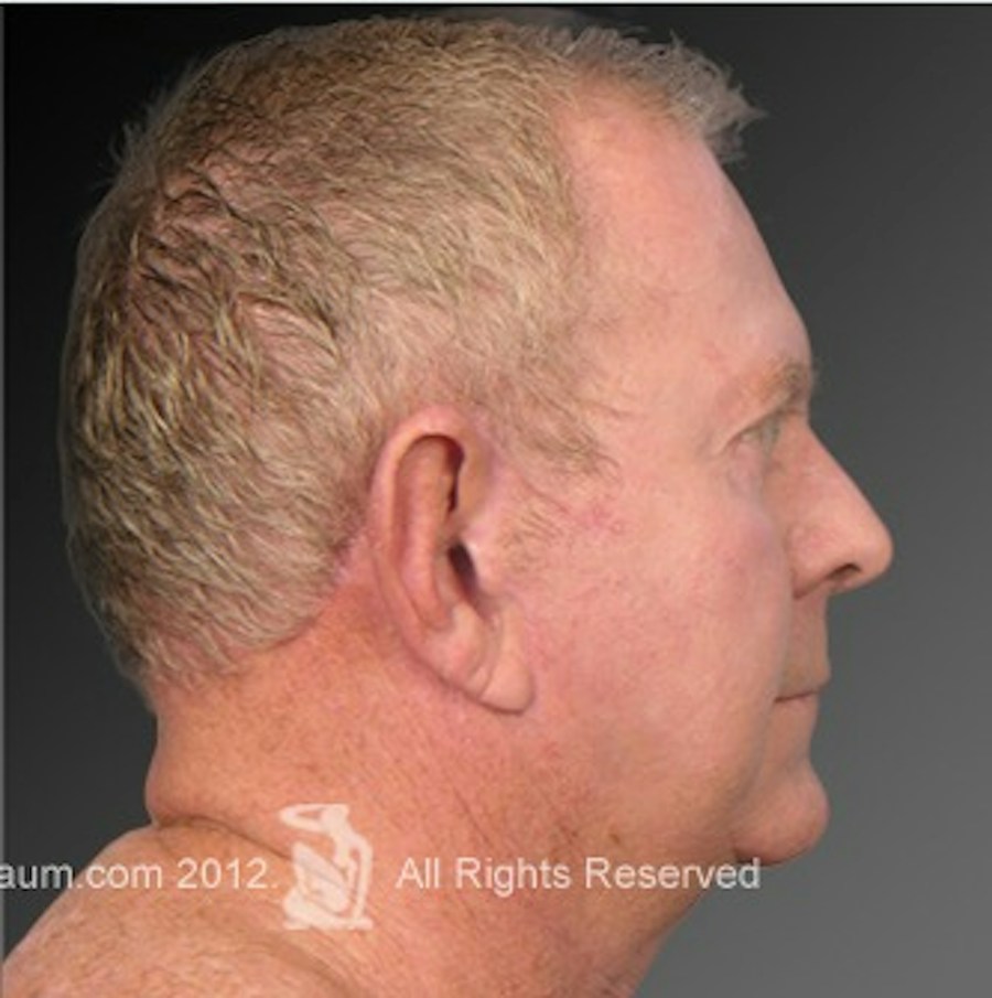 Patient 106041596 | Profile View | After | Men's Face — Steven Teitelbaum MD -