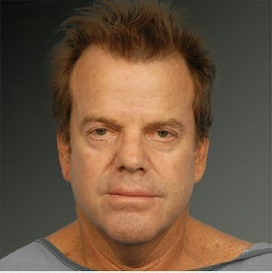 Patient 106041603 | Front View | Before | Men's Face — Steven Teitelbaum MD -