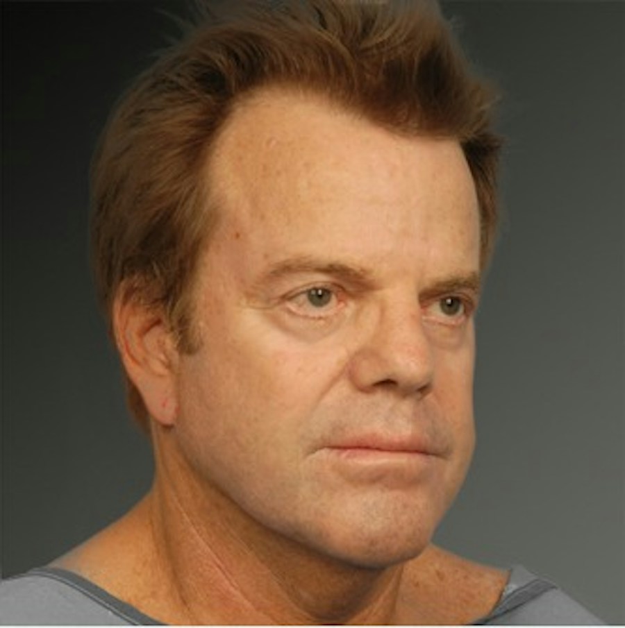 Patient 106041603 | Angle View | Before | Men's Face — Steven Teitelbaum MD -