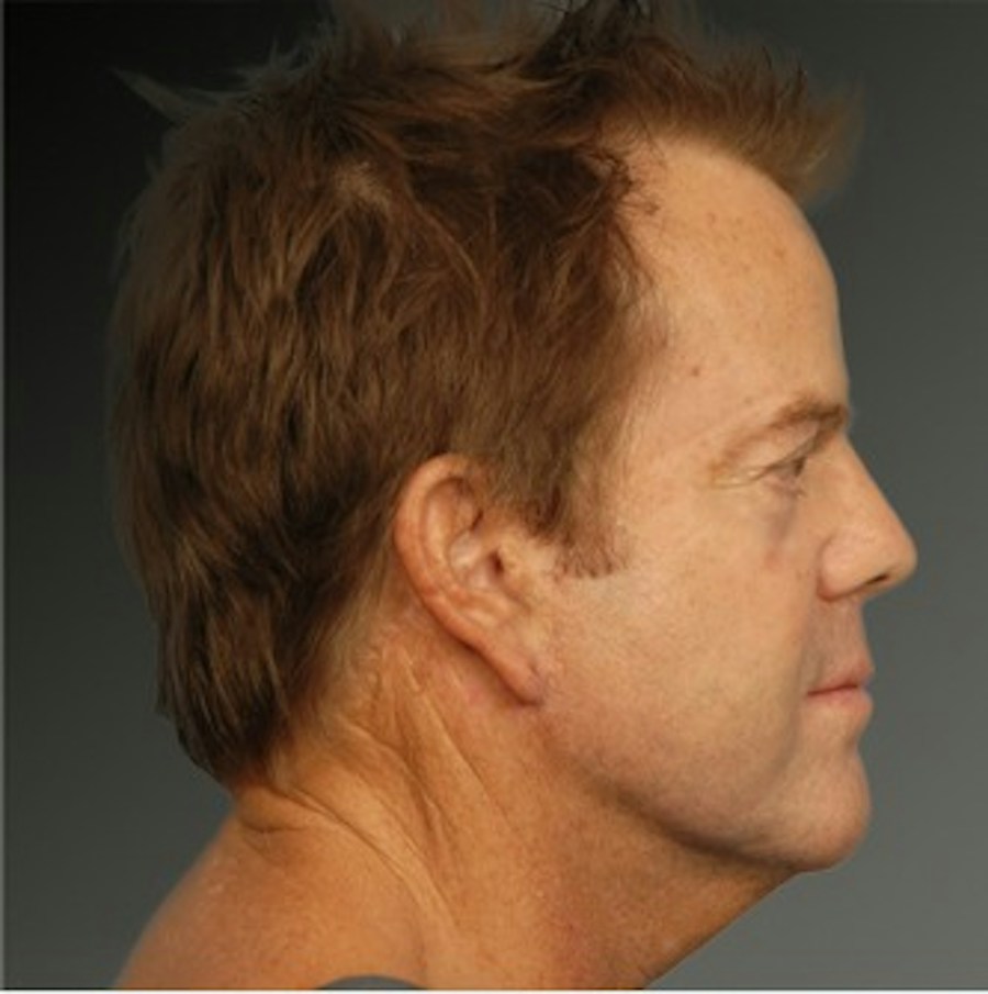 Patient 106041603 | Profile View | Before | Men's Face — Steven Teitelbaum MD -
