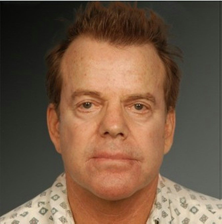 Patient 106041603 | Front View | After | Men's Face — Steven Teitelbaum MD - Santa Monica