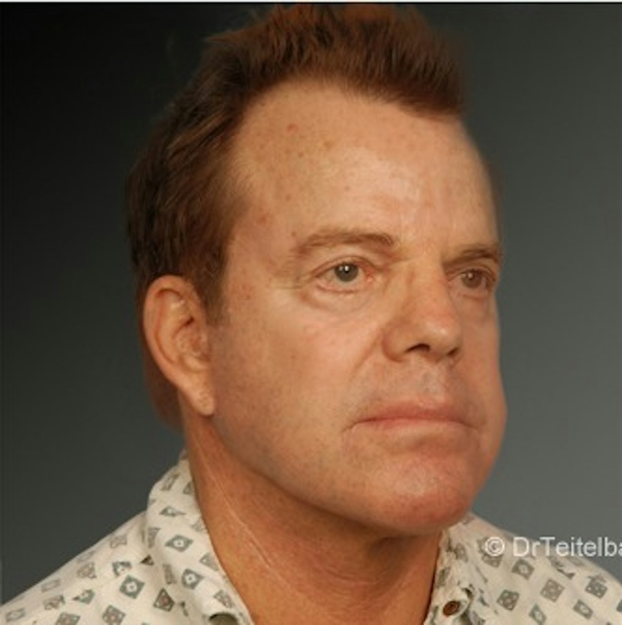 Patient 106041603 | Angle View | After | Men's Face — Steven Teitelbaum MD -