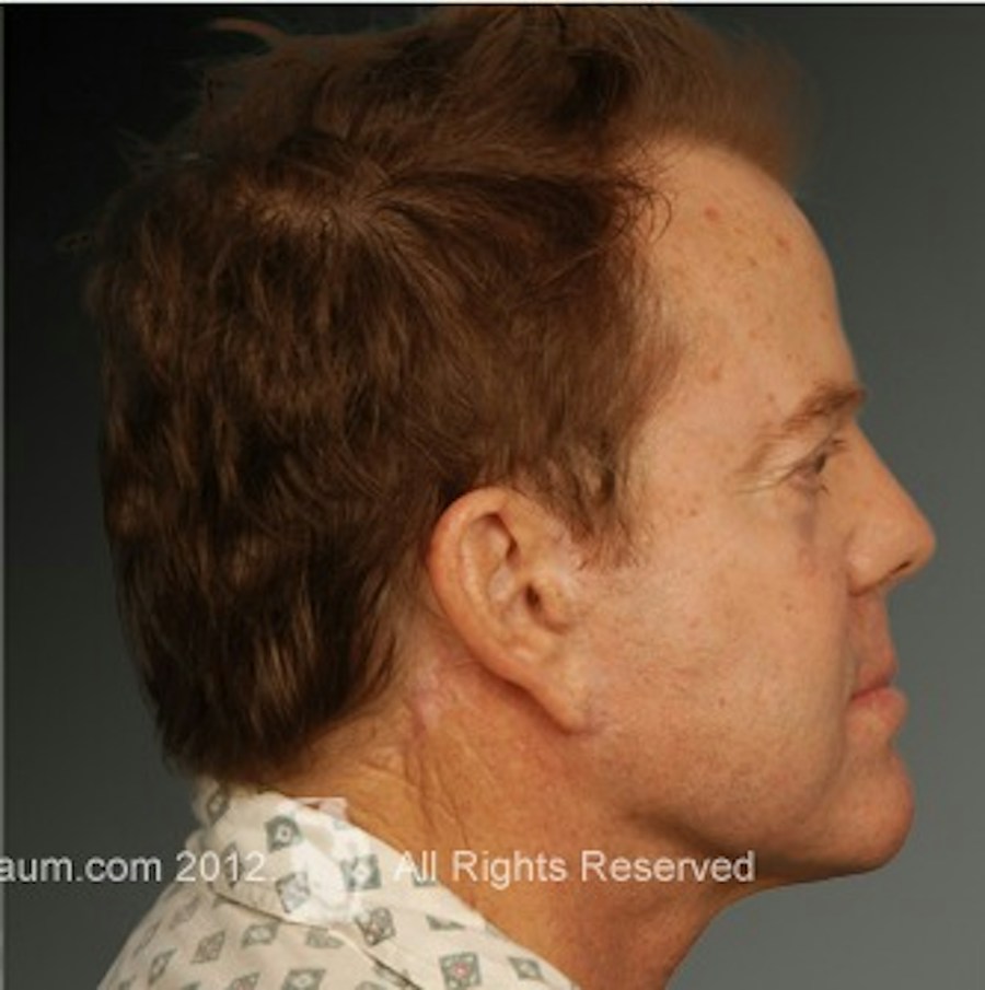 Patient 106041603 | Profile View | After | Men's Face — Steven Teitelbaum MD -