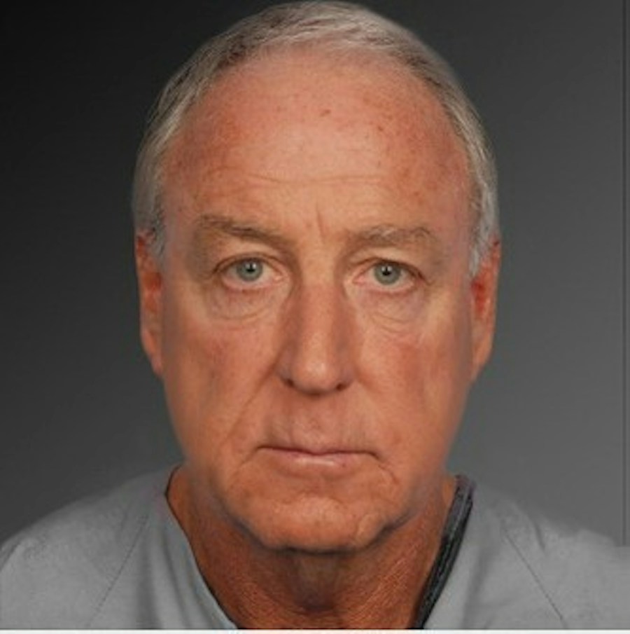 Patient 106041605 | Front View | Before | Men's Face — Steven Teitelbaum MD -