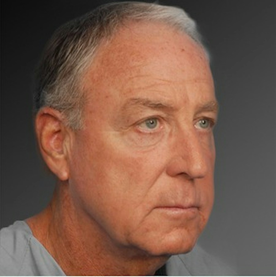 Patient 106041605 | Angle View | Before | Men's Face — Steven Teitelbaum MD -