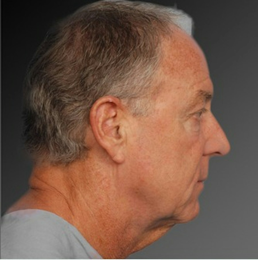 Patient 106041605 | Profile View | Before | Men's Face — Steven Teitelbaum MD -