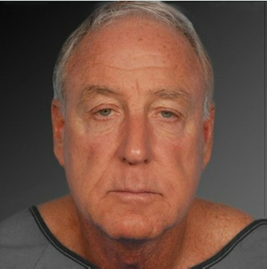 Patient 106041605 | Front View | After | Men's Face — Steven Teitelbaum MD - Santa Monica