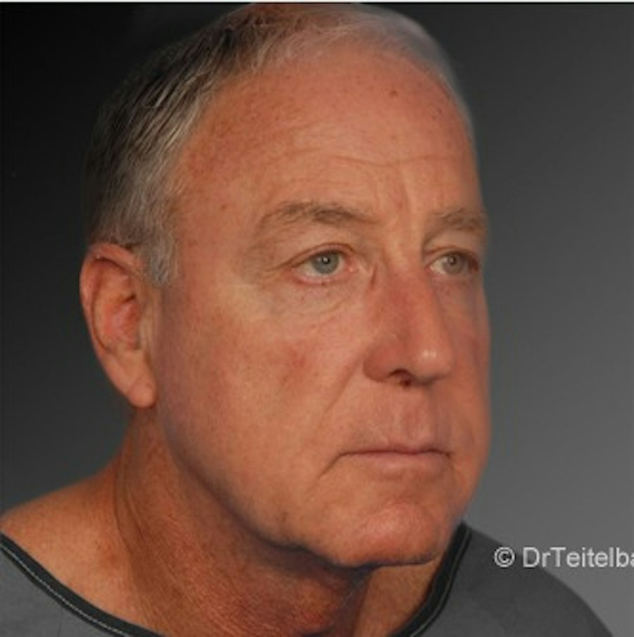 Patient 106041605 | Angle View | After | Men's Face — Steven Teitelbaum MD -