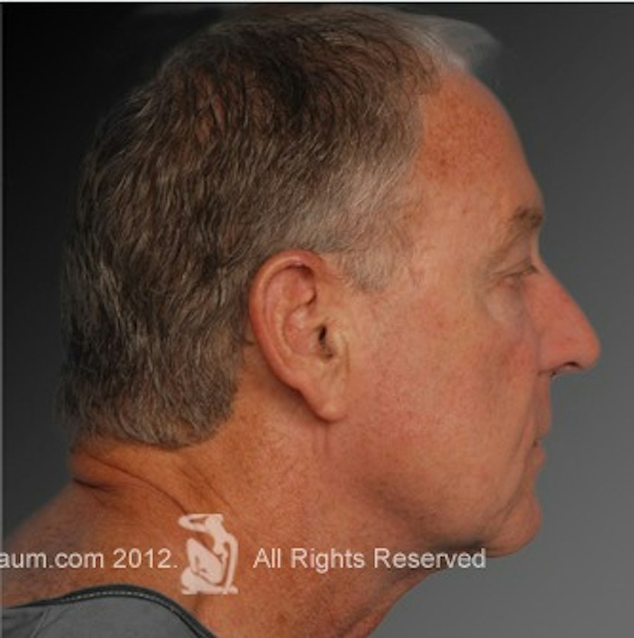 Patient 106041605 | Profile View | After | Men's Face — Steven Teitelbaum MD -