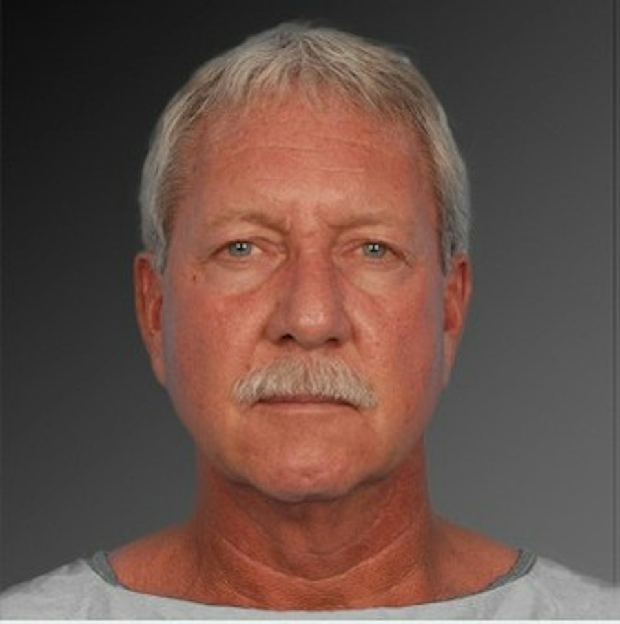 Patient 106059607 | Front View | Before | Men's Face — Steven Teitelbaum MD -