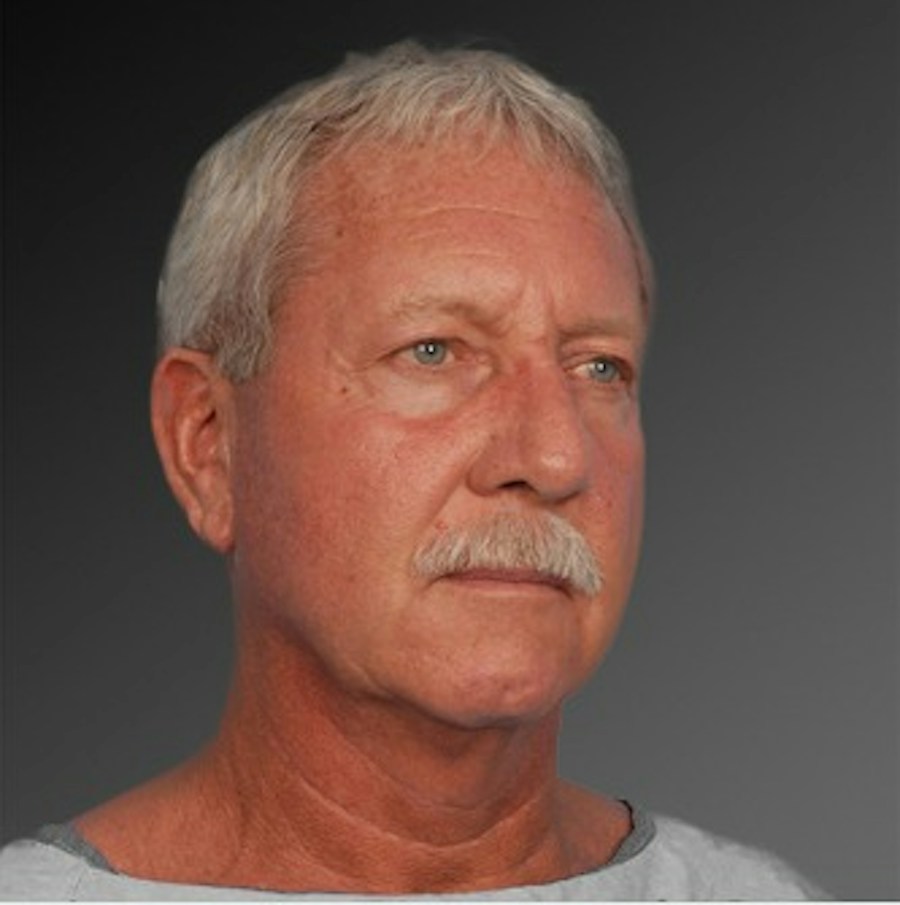 Patient 106059607 | Angle View | Before | Men's Face — Steven Teitelbaum MD -