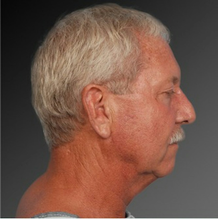 Patient 106059607 | Profile View | Before | Men's Face — Steven Teitelbaum MD -