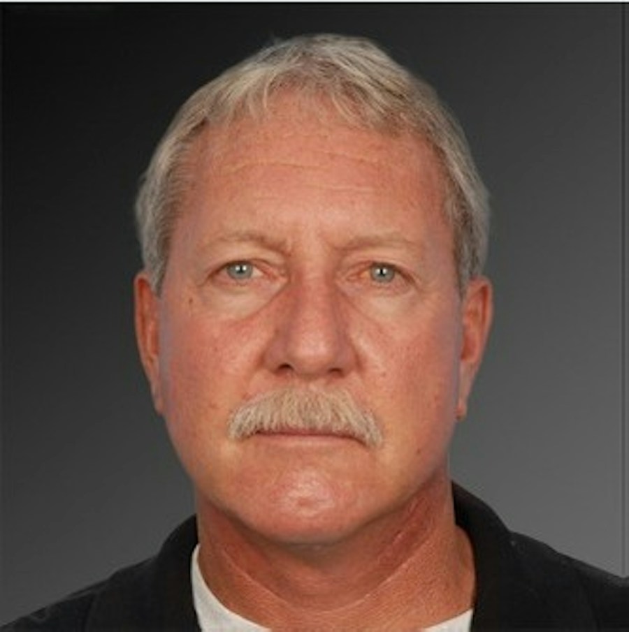 Patient 106059607 | Front View | After | Men's Face — Steven Teitelbaum MD -