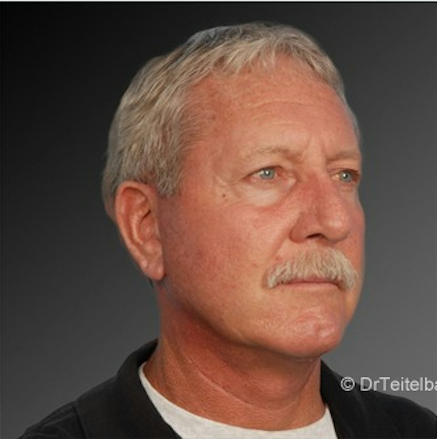 Patient 106059607 | Angle View | After | Men's Face — Steven Teitelbaum MD -