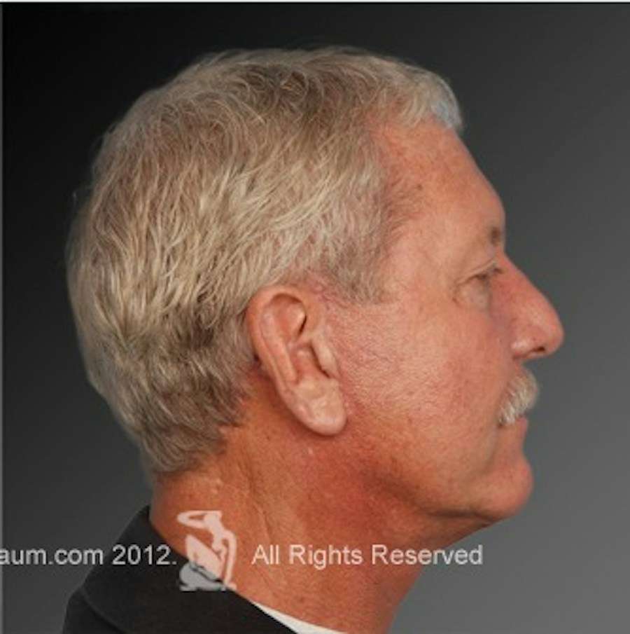 Patient 106059607 | Profile View | After | Men's Face — Steven Teitelbaum MD -