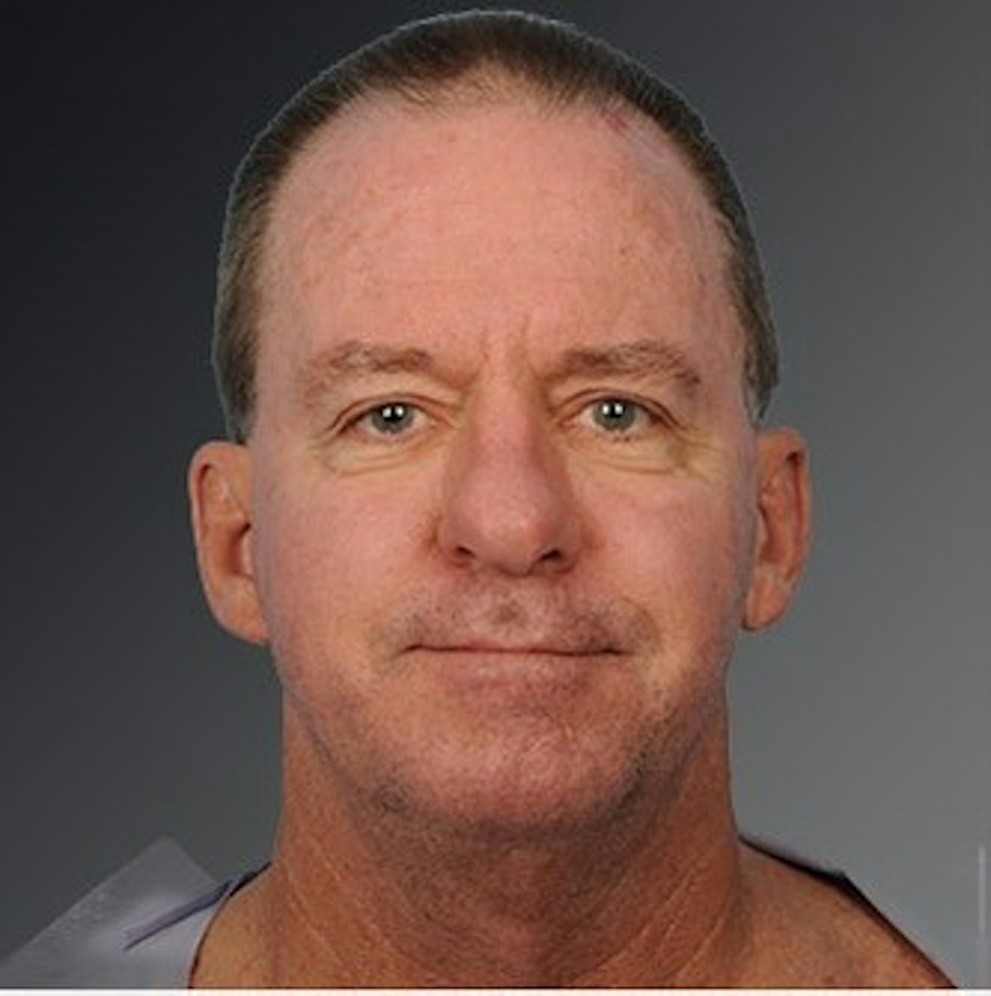 Patient 106098614 | Front View | Before | Men's Face — Steven Teitelbaum MD -