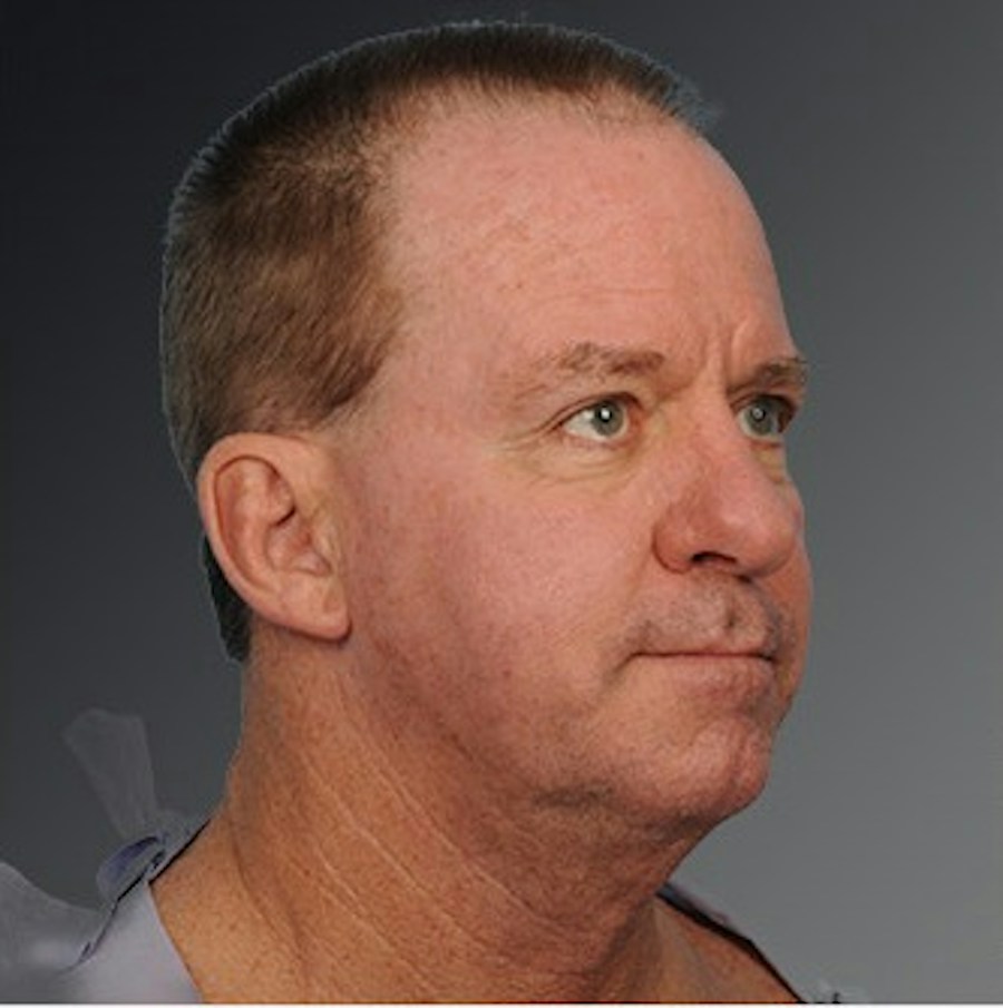 Patient 106098614 | Angle View | Before | Men's Face — Steven Teitelbaum MD -