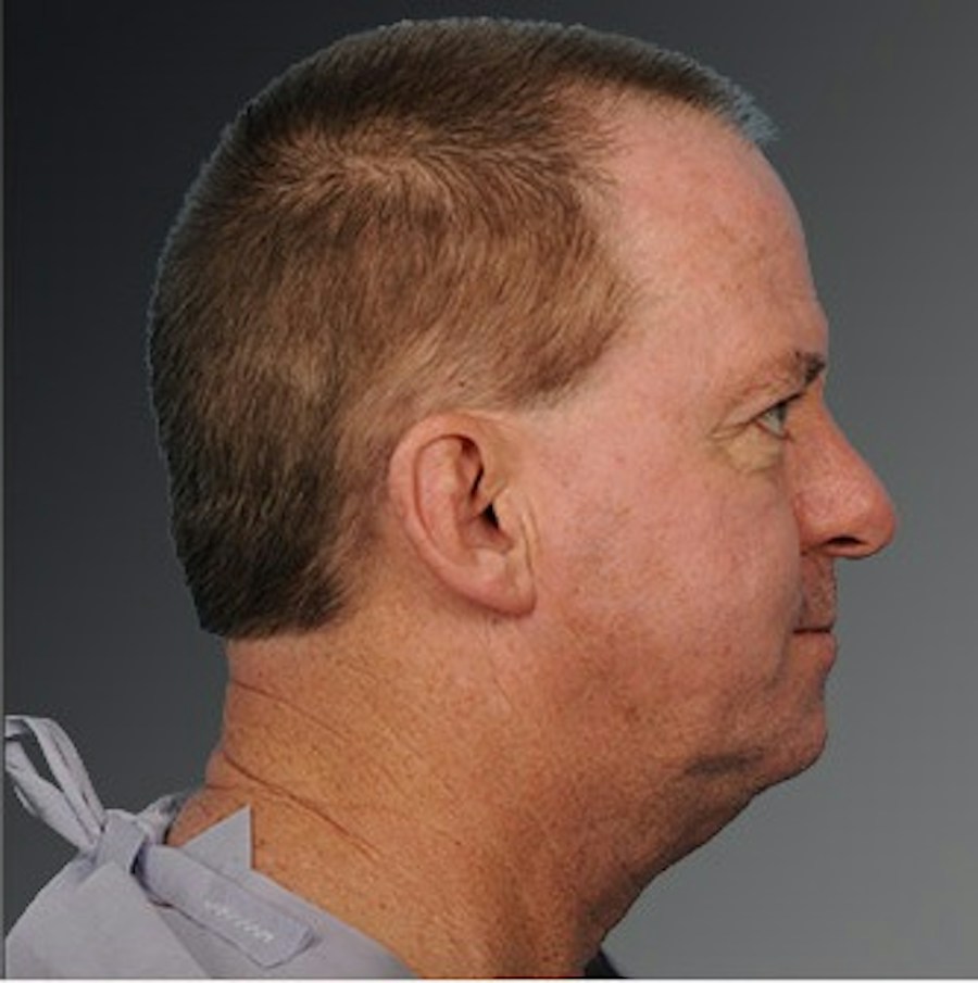 Patient 106098614 | Profile View | Before | Men's Face — Steven Teitelbaum MD -