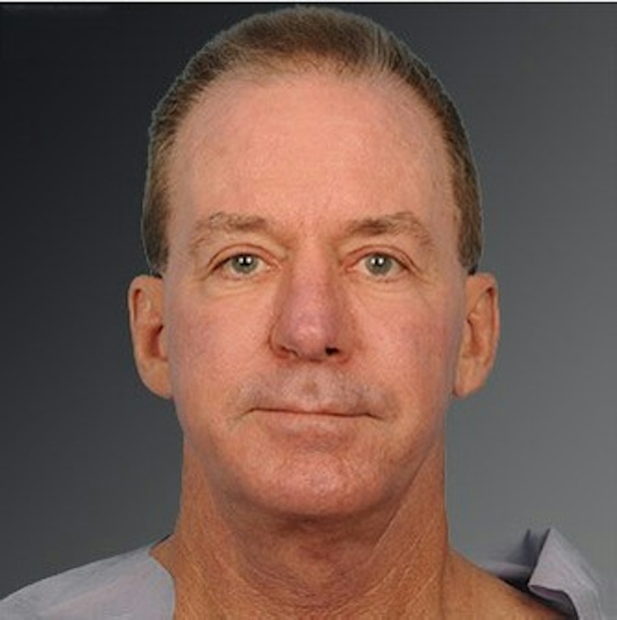 Patient 106098614 | Front View | After | Men's Face — Steven Teitelbaum MD -