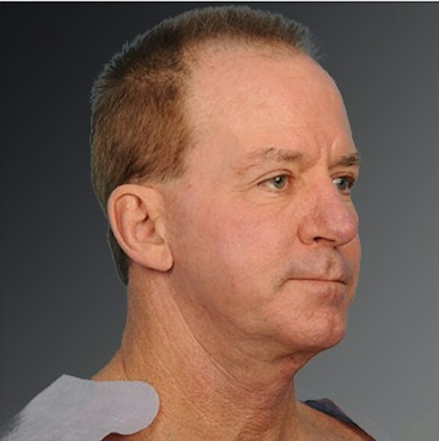Patient 106098614 | Angle View | After | Men's Face — Steven Teitelbaum MD -