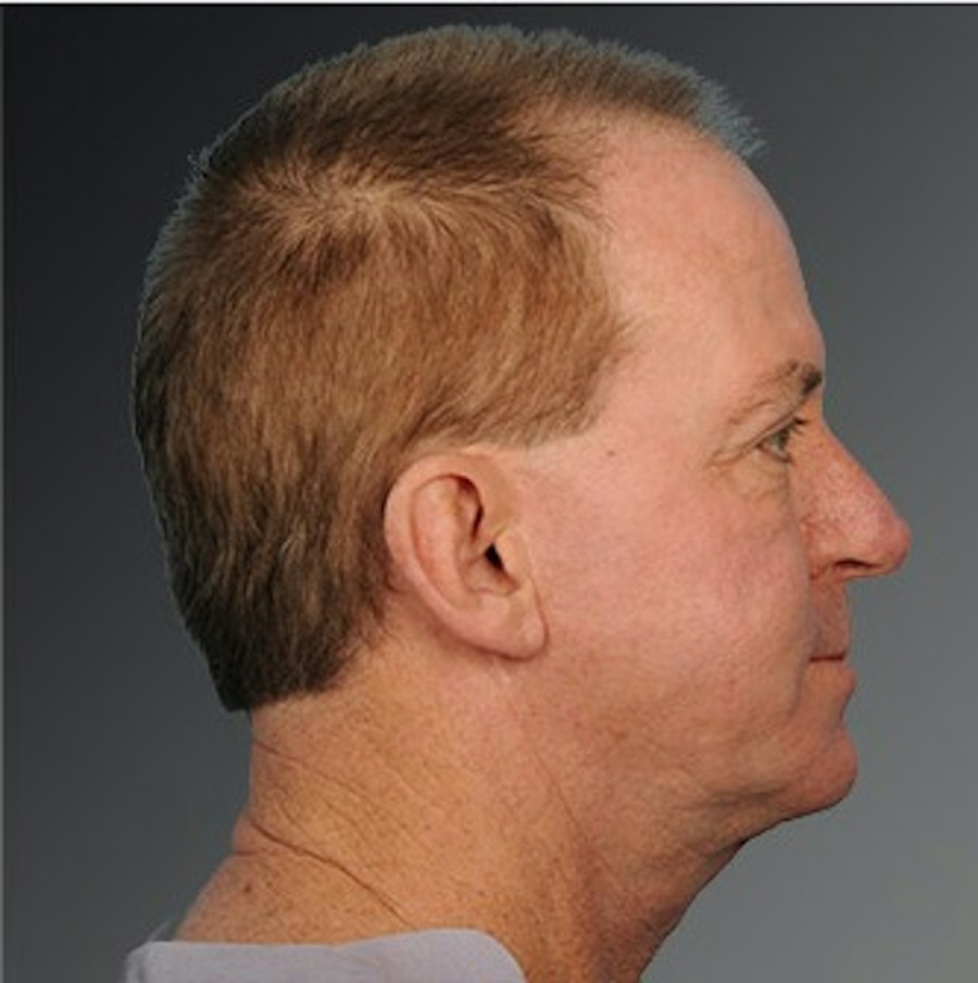 Patient 106098614 | Profile View | After | Men's Face — Steven Teitelbaum MD -