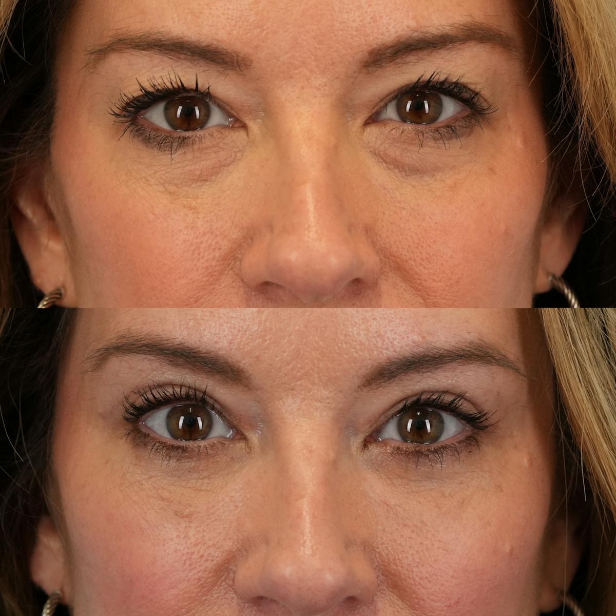Lower Eyelids Before & After Gallery - Patient 390707 - Image 1