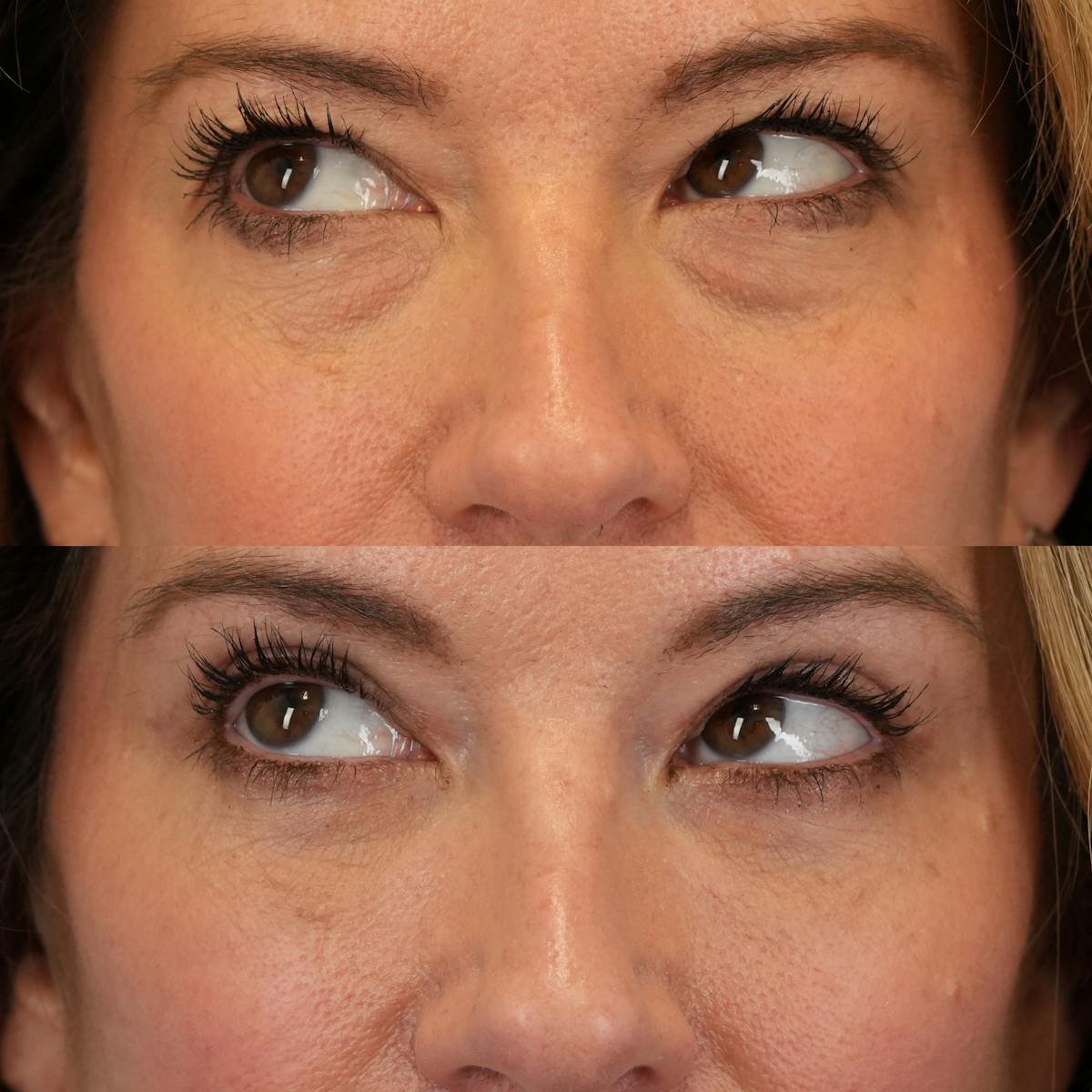 Lower Eyelids Before & After Gallery - Patient 390707 - Image 5