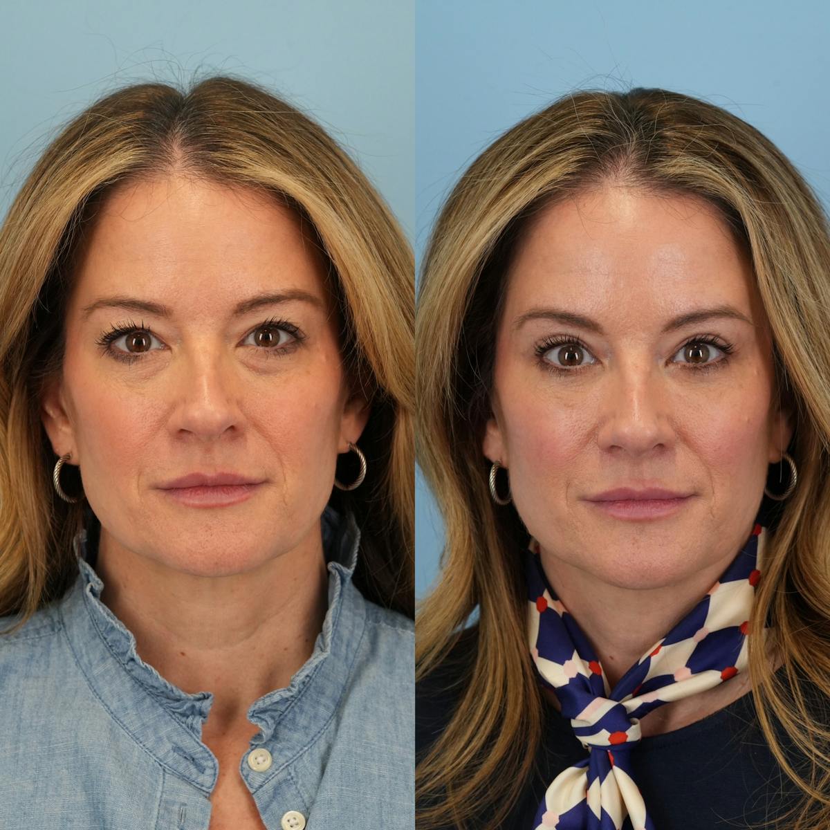 Lower Eyelids Before & After Gallery - Patient 390707 - Image 6
