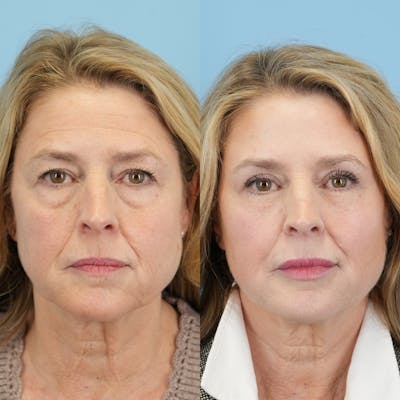 Fat Grafting Before & After Gallery - Patient 387125 - Image 1