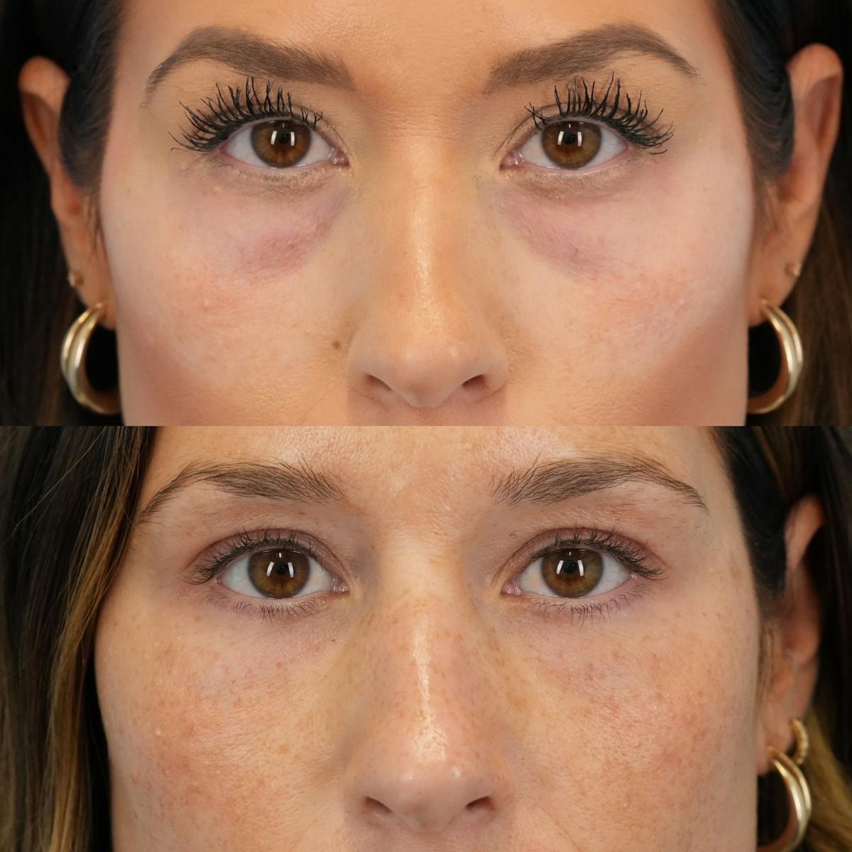 Blepharoplasty Before & After Gallery - Patient 121304 - Image 1