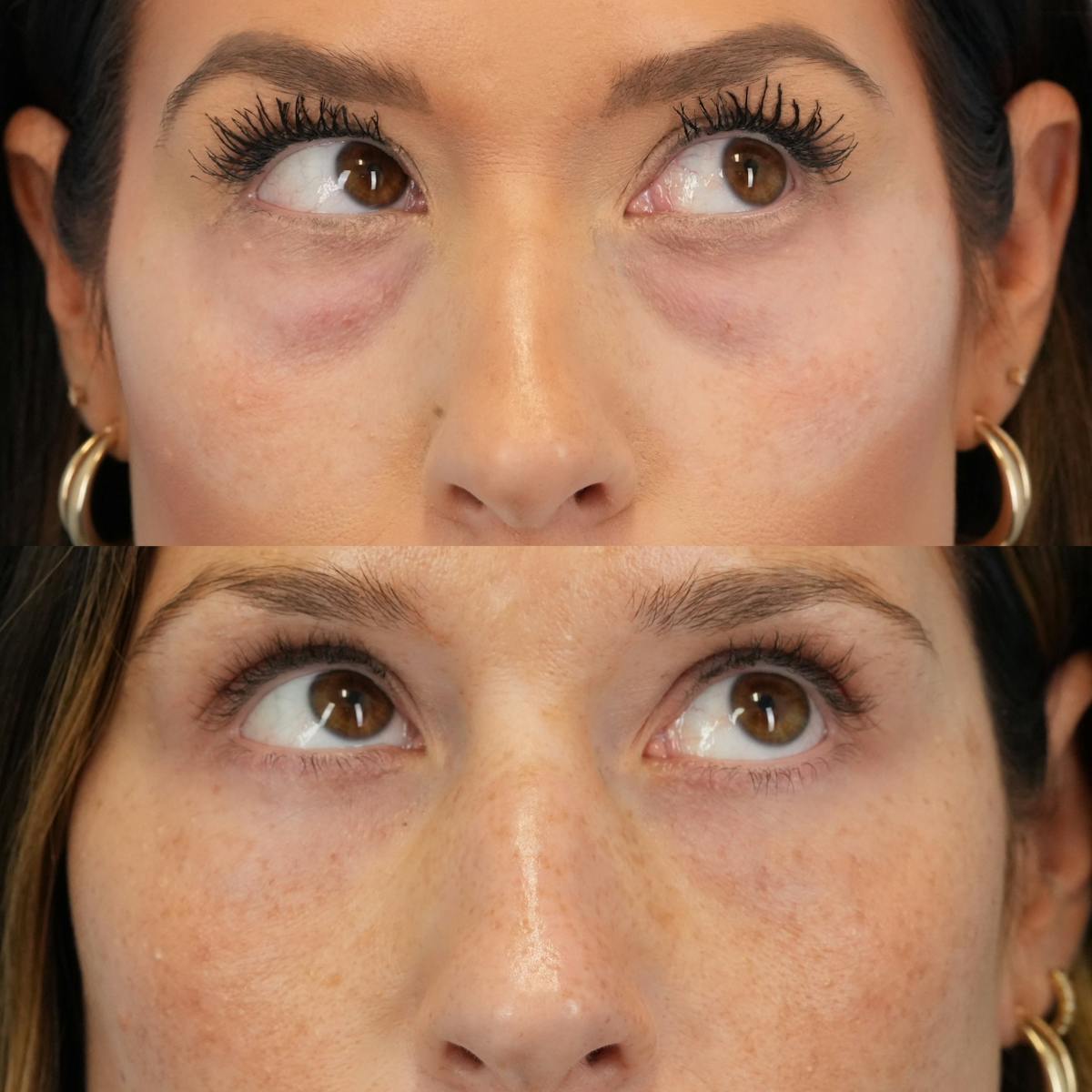 Blepharoplasty Before & After Gallery - Patient 121304 - Image 3