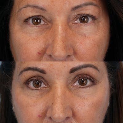 Blepharoplasty Before & After Gallery - Patient 253237 - Image 1