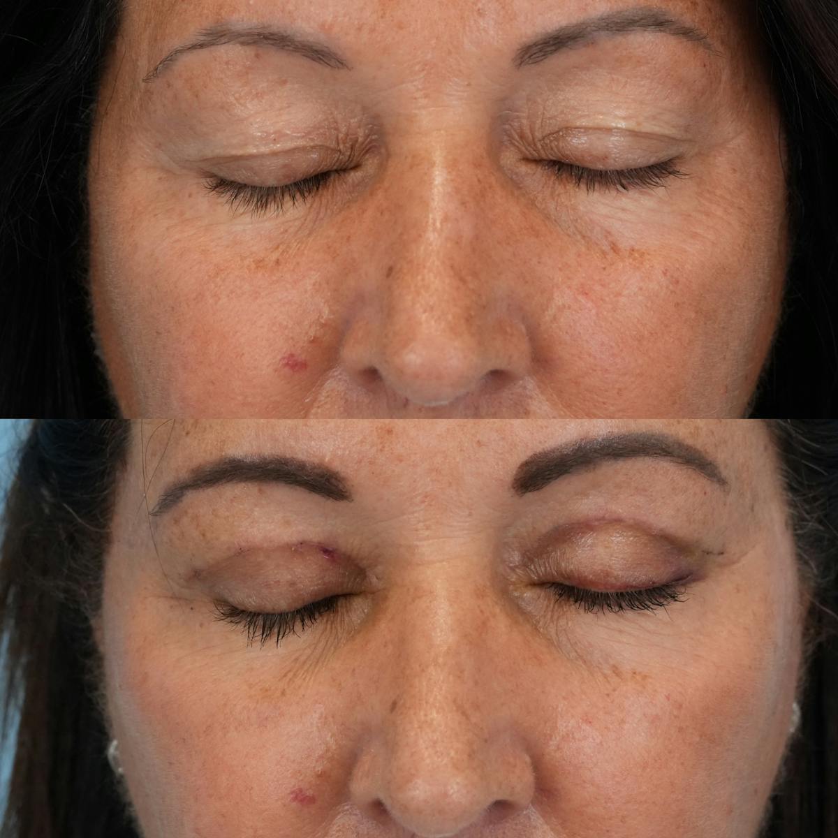 Blepharoplasty Before & After Gallery - Patient 524773 - Image 2
