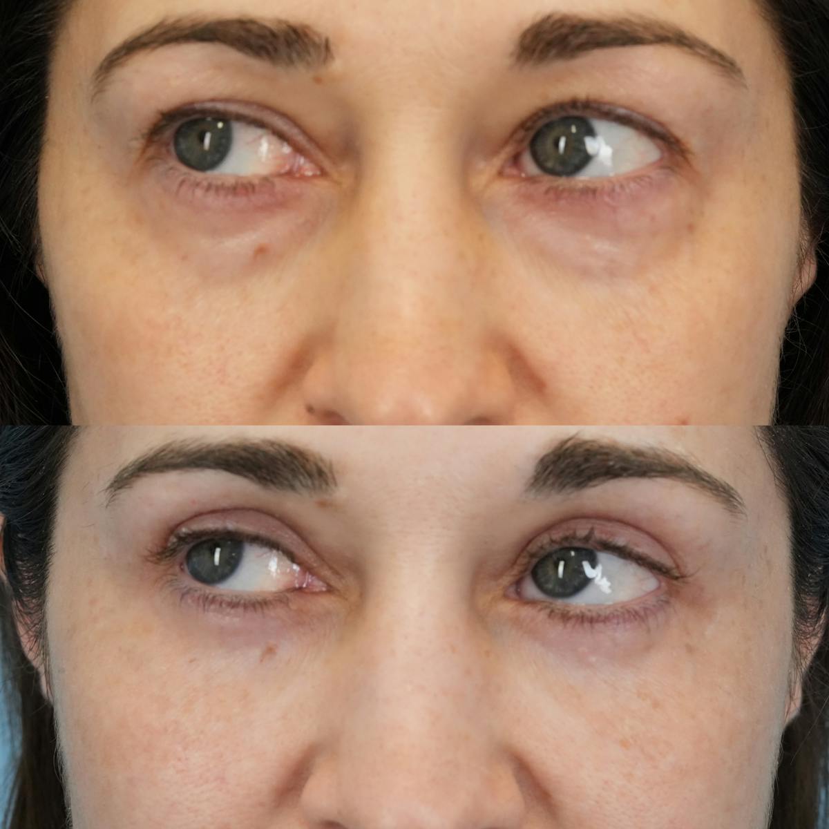 Blepharoplasty Before & After Gallery - Patient 272705 - Image 5